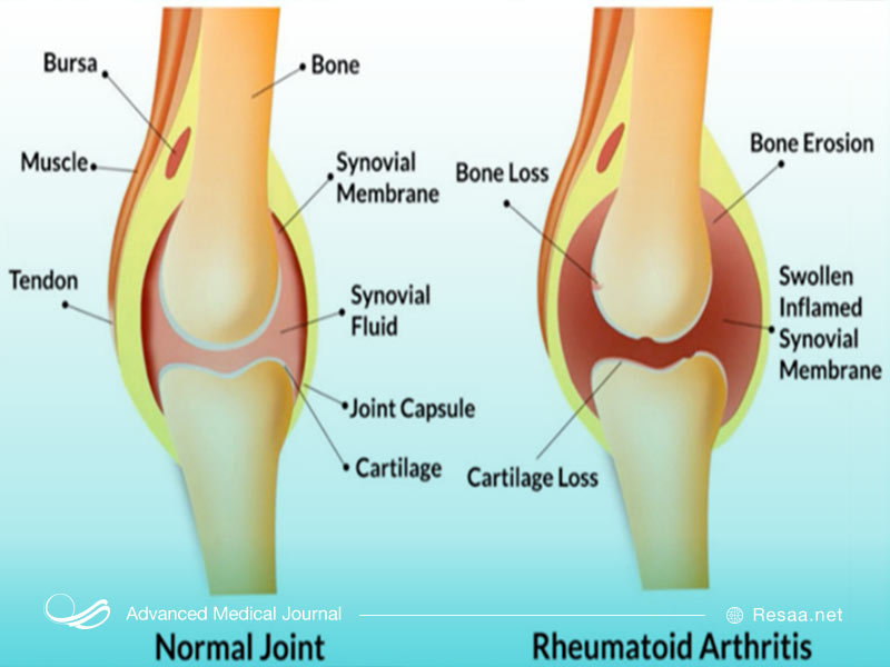 چه عواملی باعث ایجاد ارتریت میشوند؟