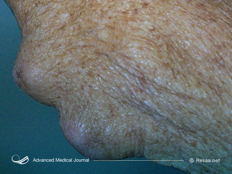 تصویری از بیمار مبتلا به ارتریت