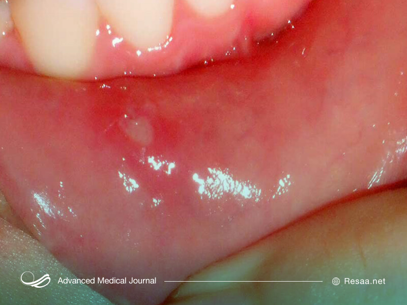 آفت دهانی باعث بروز زخم‌ها و حفره‌های کوچک داخل دهان می‌شود.