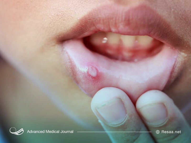 تبخال دهانی بسیار دردناک است.