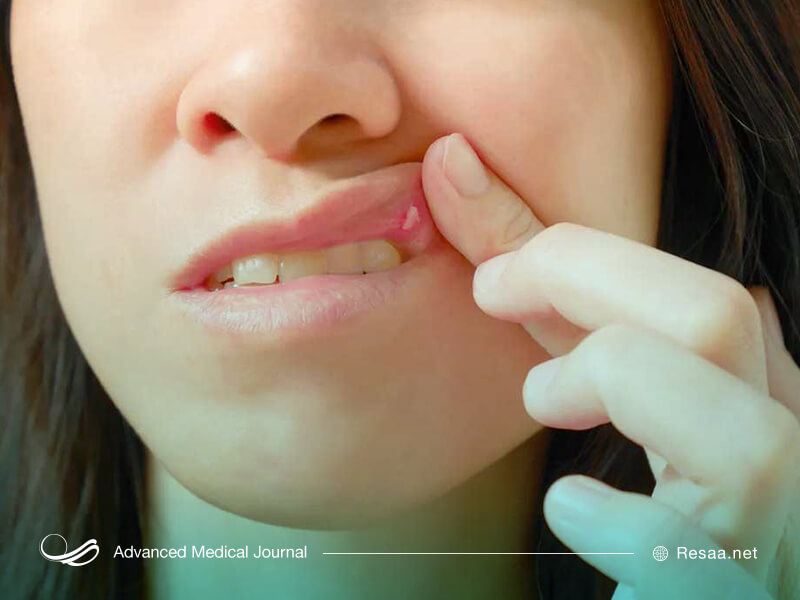 کمبود ویتامینها باعث آفت دهان میشوند.