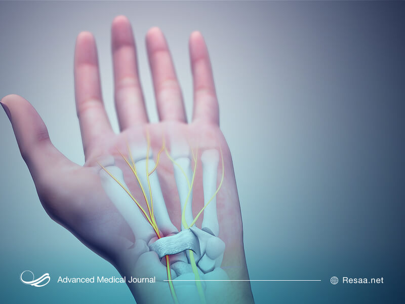 تونل کارپال در کجای بدن قرار دارد