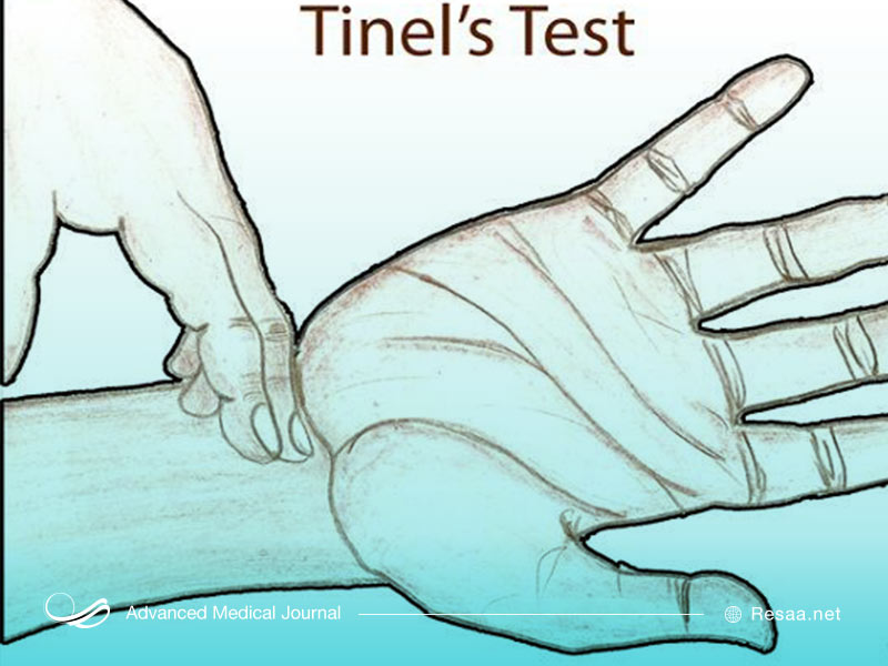 آزمایش تینل برای بررسی وضعیت دست