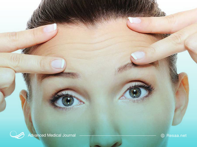 لیفت پیشانی