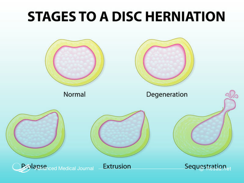 تصویری از مراحل پاره شدن دیسک گردن