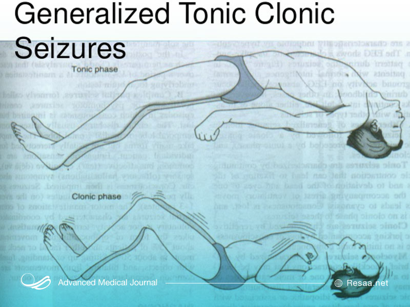 وضعیت بدن در حالت تشنج