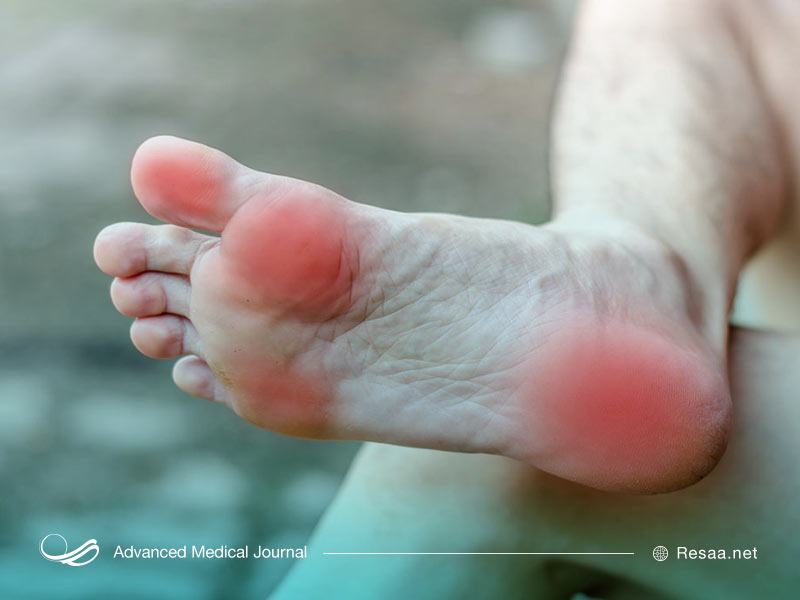 درد توپی پا در اثر استفاده از کفشها نامناسب ایجاد می شود.