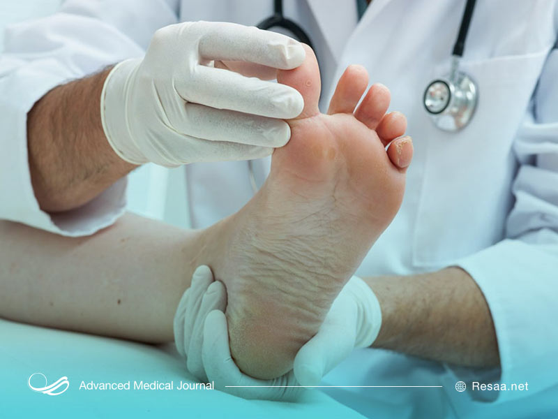 درد زیر شست پا یا سزاموئیدیت نوعی تاندونیت است.