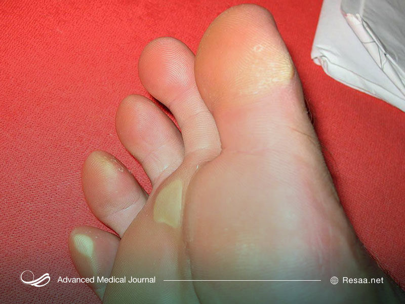 انگشت شست پای چکشی نوعی آرتروز در انگشت شست پا میباشد.