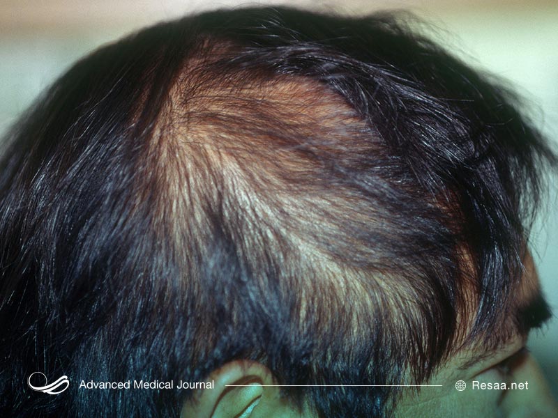 چرا دچار ریزش مو میشویم