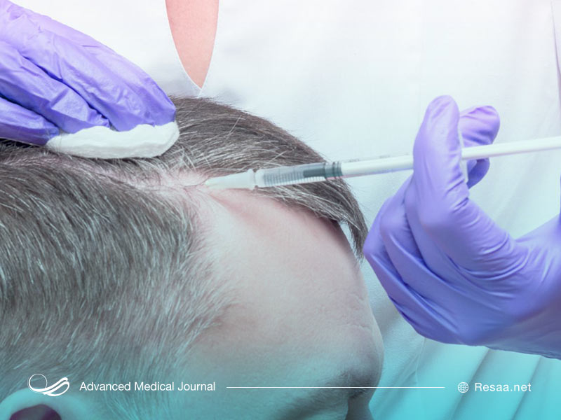 تزریق کورتیزون به پوست سر