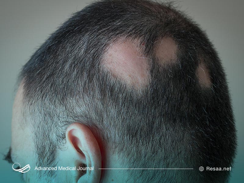 تشخیص ریزش موی غیر طبیعی