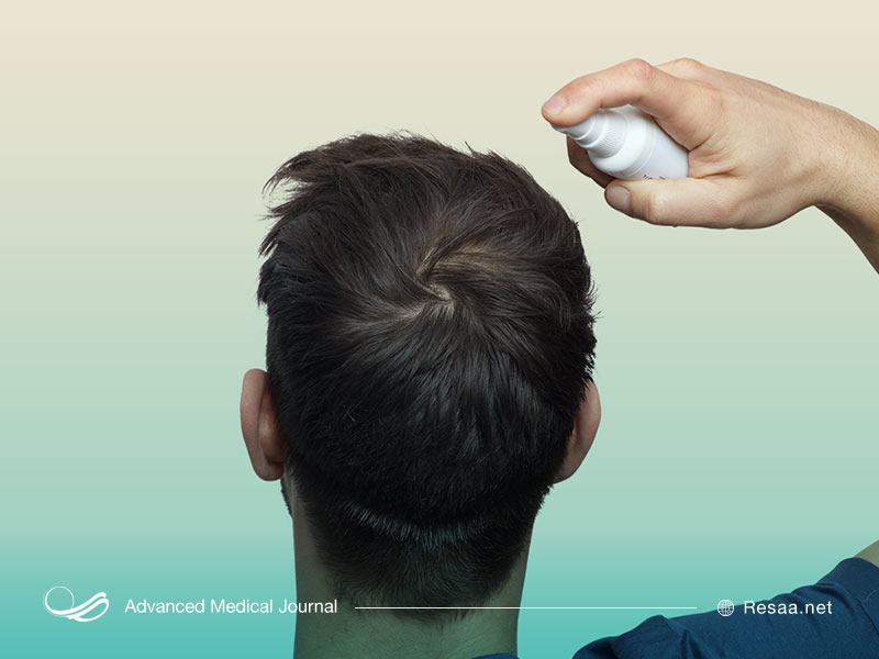درمان ریزش مو