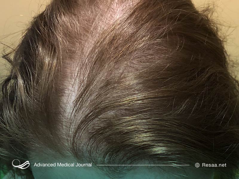 ریختن موها به تعداد معینی در روز غیرطبیعی نیست