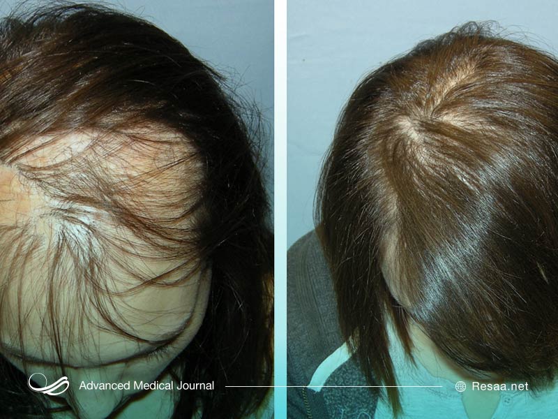 علت ریزش موی ناگهانی باید بررسی شود