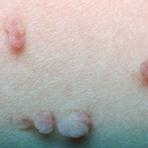 زگیل تناسلی چیست