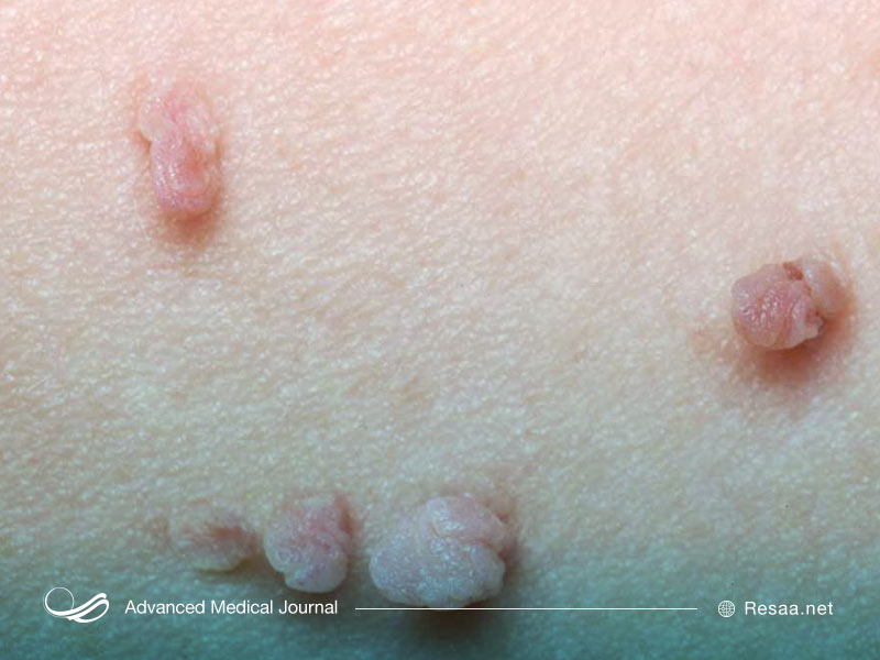 تصویری از زگیلهای تناسلی