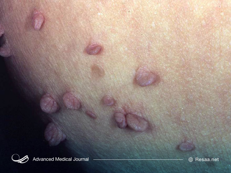 زگیلهای تناسلی قابل بازگشت هستند