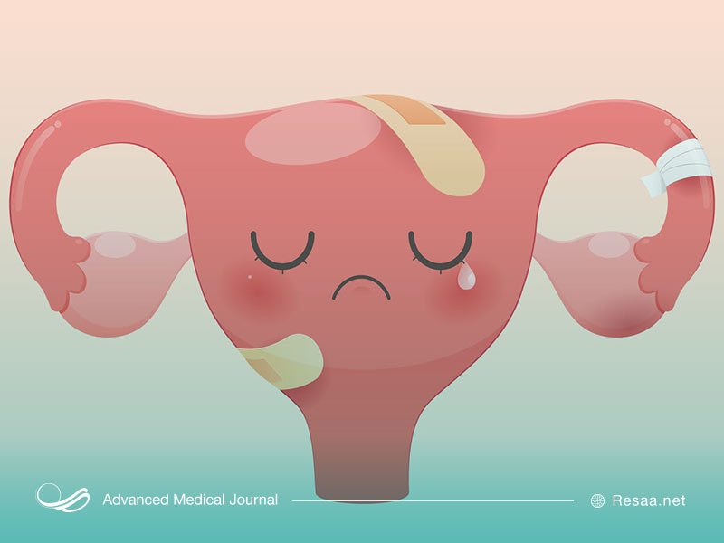 زگیل تناسلی در زنان