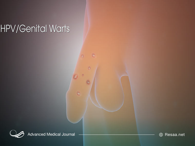 جراحی برای درمان اچ پی وی