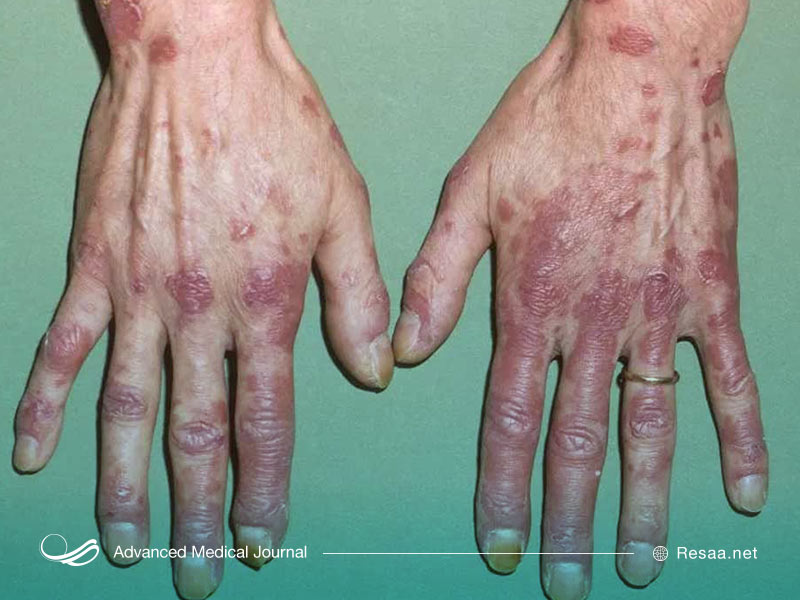 درگیری پوستی در بیماری لوپوس که در تصویر مشهود است