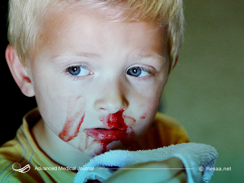 خون دماغ شدن به دلایل مختلفی رخ میدهد