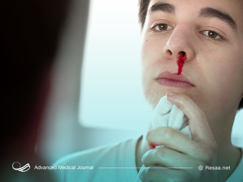 ضربه به بینی و خونریزی بینی