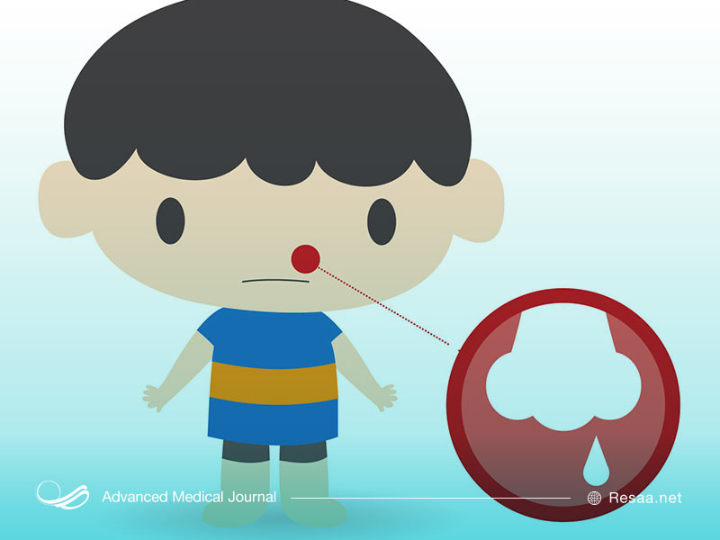 چرا خون دماغ میشویم