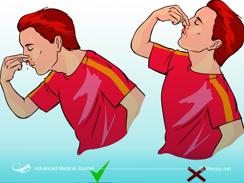 برخورد صحیح هنگام خون دماغ شدن