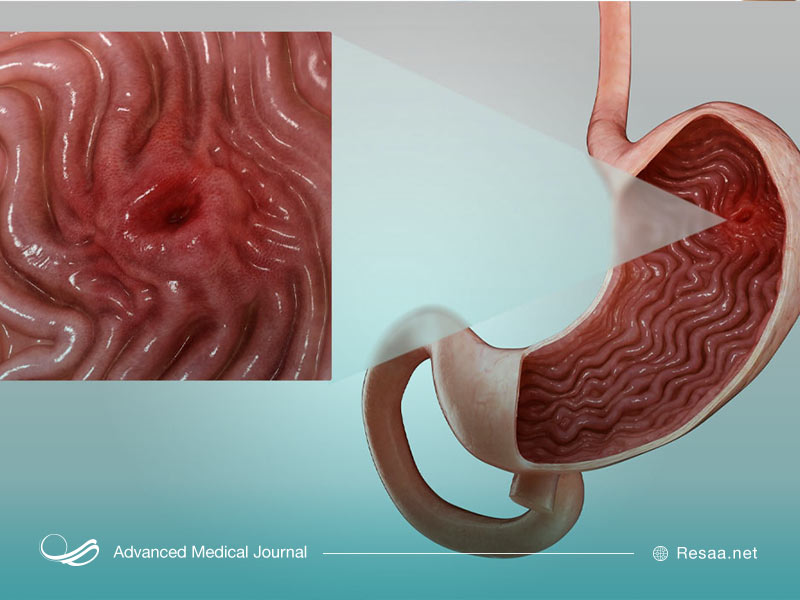 سوراخ شدن معده