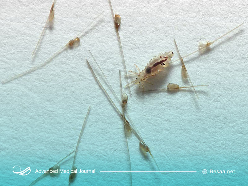 خارش سر ممکن است یکی از علائم شپش سر باشد.