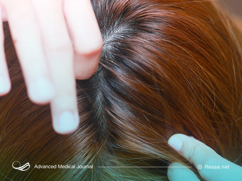 انتقال شپش به افراد دیگر