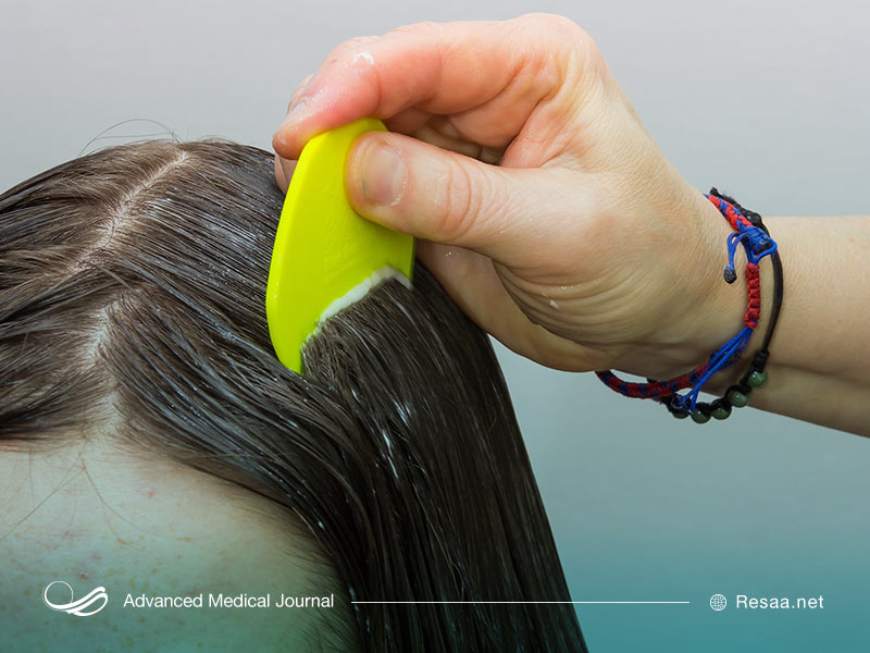 مناطق درگیر شپش در پوست سر شامل پشت گوشها و اطراف گردن میباشد.