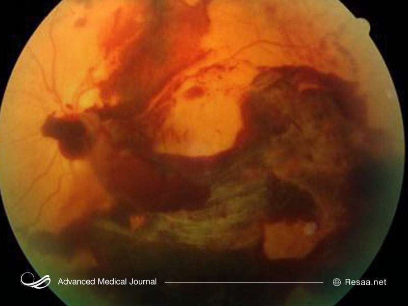 خونریزی زجاجیه در بیماری رتینوپاتی دیابتی