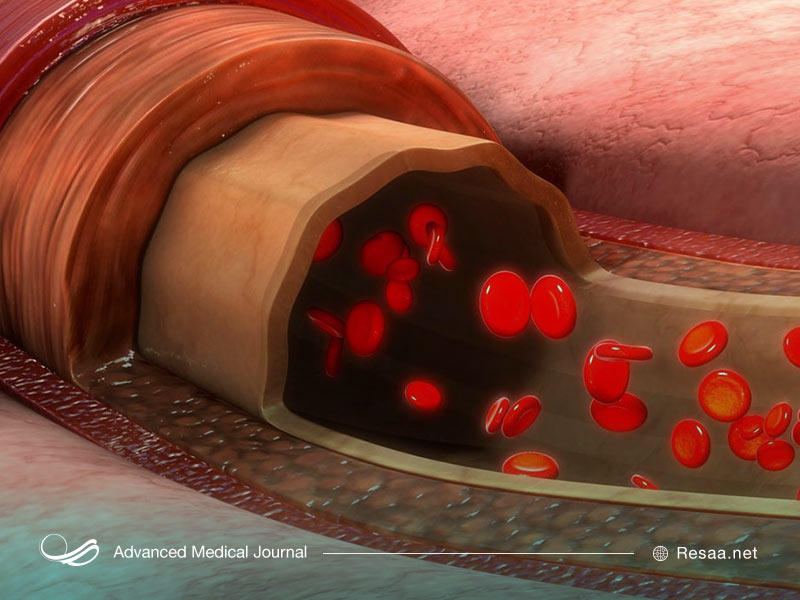 دلیل پلاکت خون بالا