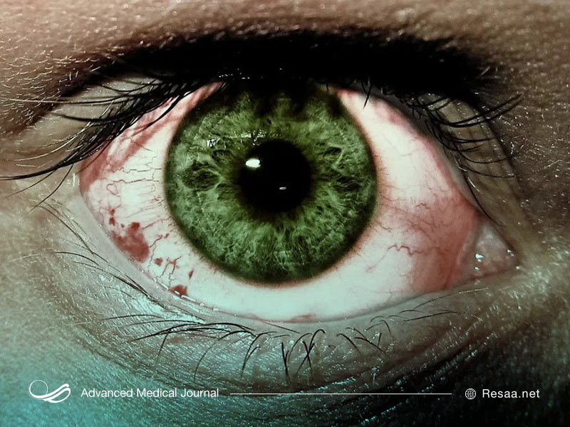 درمان تیروئید چشمی