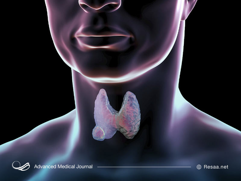 ندول تیروئید میتواند به دلایل متفاوتی ایجاد شود.