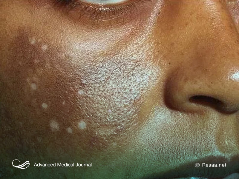 روش تشخیص بیماری آدیسون