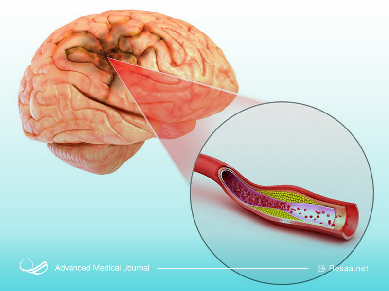 آنوریسم چیست؟