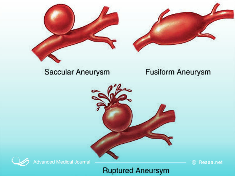آسیب شریان بزرگ