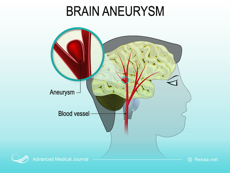علایم آنوریسم