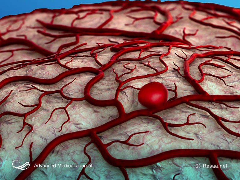 آنوریسم مغزی