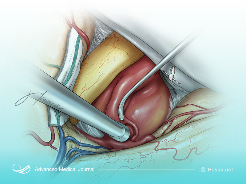 آنوریسم در مناطق مختلف بدن