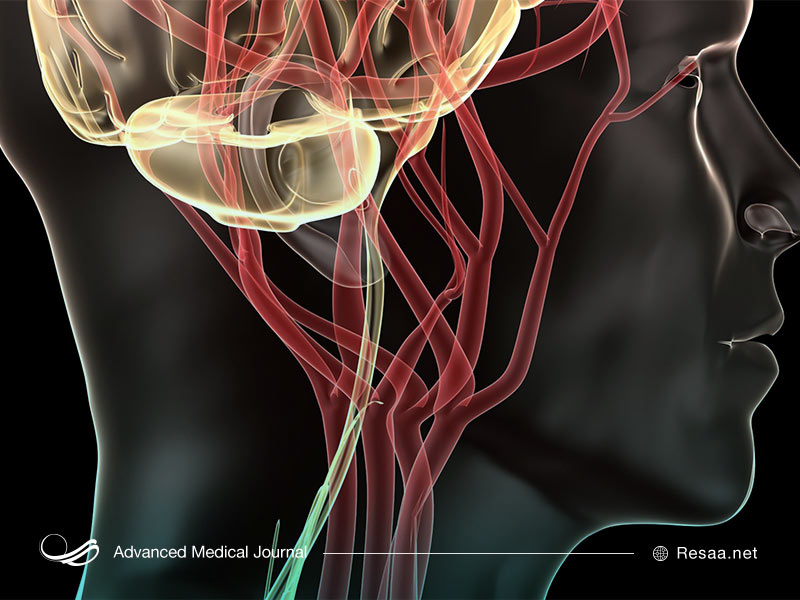 تشخیص آنوریسم