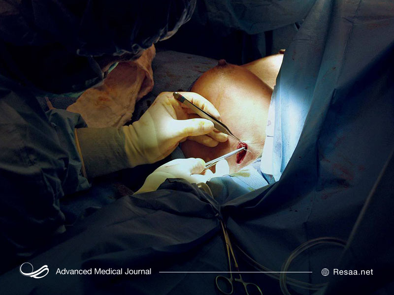 فلپ های شکمی