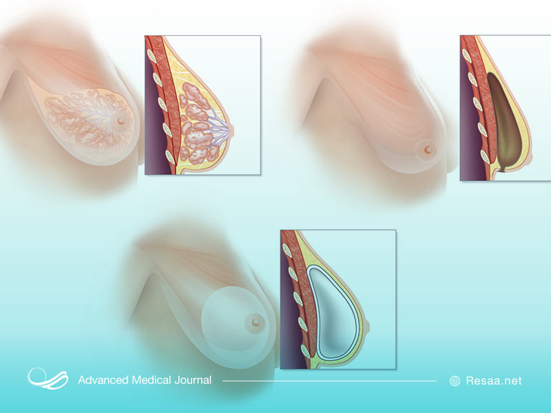ترمیم سینه با بافت اتولوگ