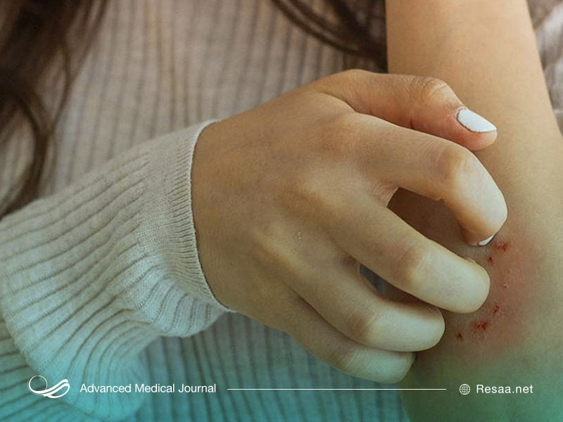 آبله مرغان مسری است