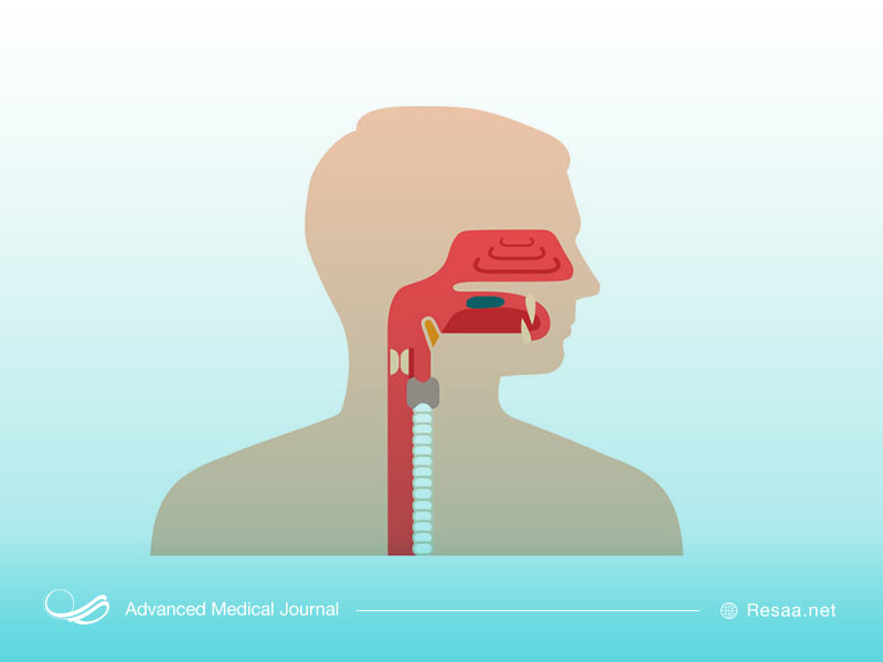 علت بروز دیسفاژی
