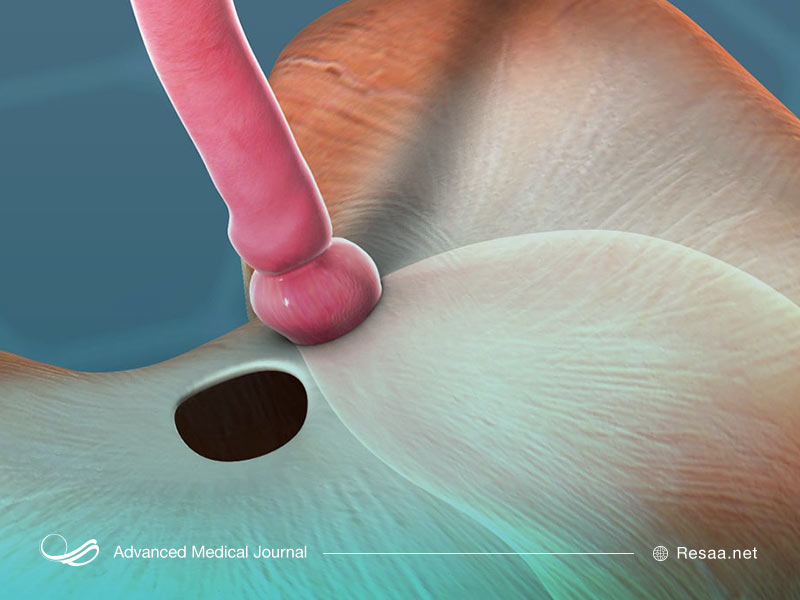فتق سبب تخلیه حفره‌های بدن می‌شود.