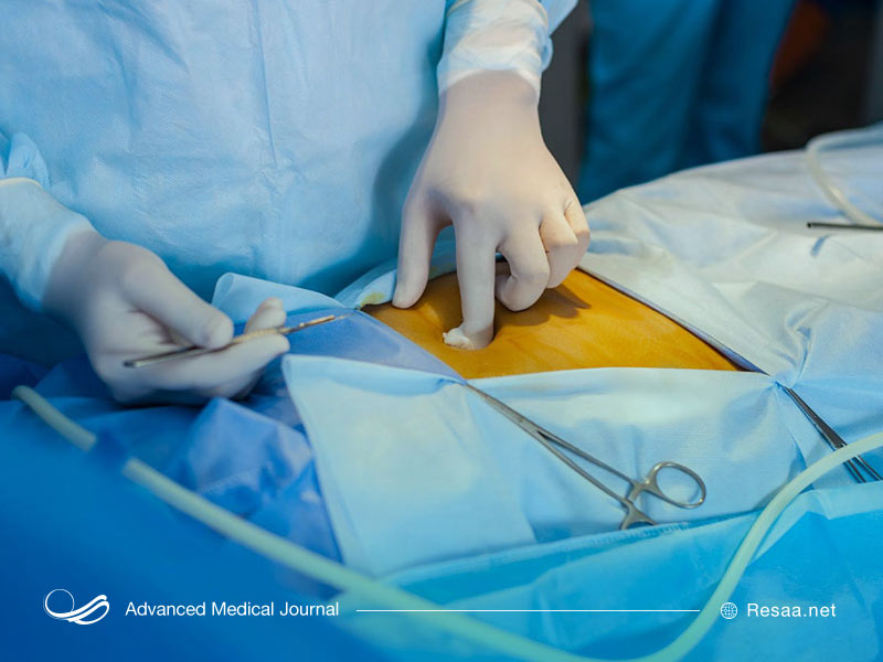 فتق با جراحی قابل درمان است